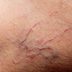 10 Ways to Erase Broken Capillariesâ€”and Prevent Them Completely