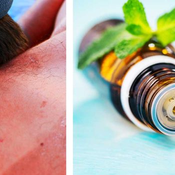 06-How-to-Treat-Sunburn-With-Essential-Oils_shutterstock-ft