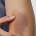 What the Color of Your Bruise Is Trying to Tell You