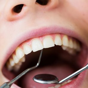 Close-up of female with open mouth during oral checkup at the dentist.Dentist