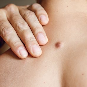 Fibroma on the male back, details, close-up