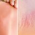 Heat Rash or Sunburn: Hereâ€™s How to Tell the Difference