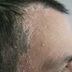 10 Things Dermatologists Wish You Knew About Scalp Psoriasis