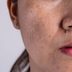 What is Hyperpigmentation? What to Know About Dark Spots and Skin Discoloration