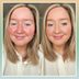 Here's How a Beauty Pro Keeps Her Rosacea Under Control