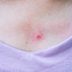 Sweat Pimples: How To Treat and Prevent Them, from a Board-Certified Dermatologist